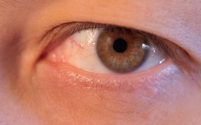 What Should I Know Before Getting Tear Duct Surgery?