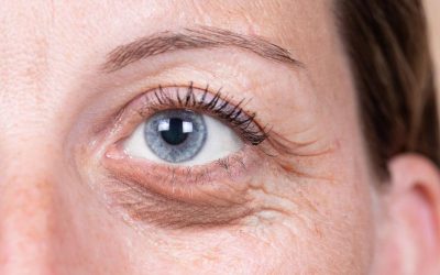 What Should You Know About the Anatomy Behind Eye Bag Surgery?