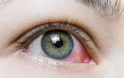 When Should You Seek Treatment for Ectropion Eye?