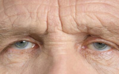 Wrinkles on Forehead: When Do They Become a Cosmetic Concern?
